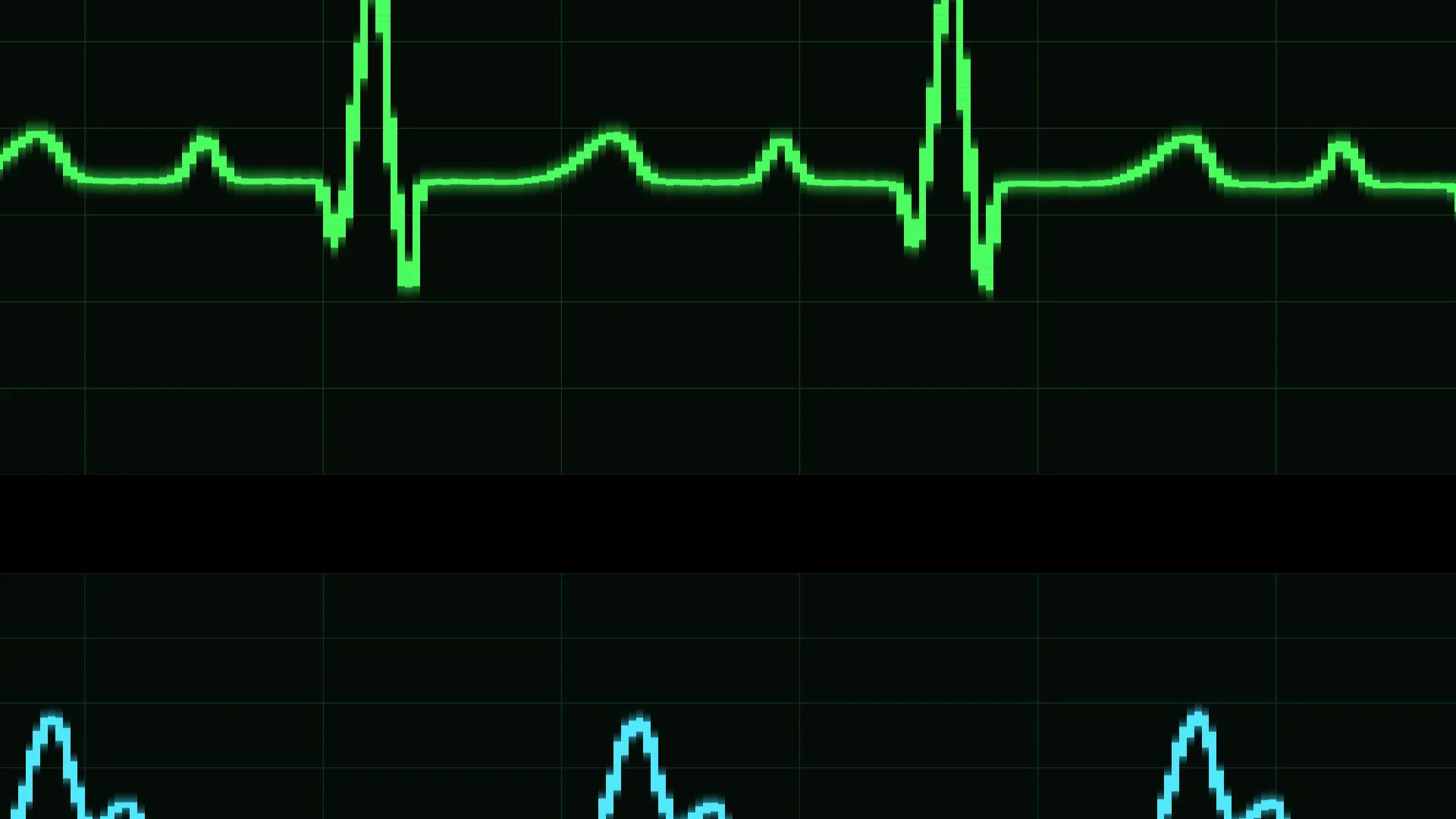 A close view of a continuous ECG trace